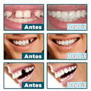 Sorriso novo em minutos! Facetas Dentárias (Natural e confortável!)